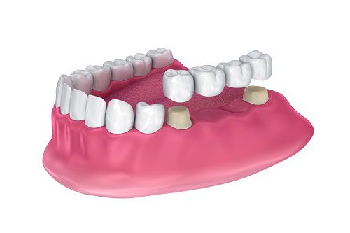 puentes dentales fijos